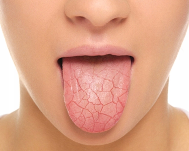 Common Medications That Can Cause Dry Mouth – And What to Do About It